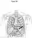 Fig. 08 - Subcutaneous cardiac rhythm management with disordered breathing detection and treatment