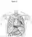 Fig. 09 - Subcutaneous cardiac rhythm management with disordered breathing detection and treatment