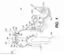 Fig. 02 - Using a genetic algorithm to fit a cochlear implant system to a patient