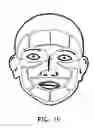 Fig. 16 - Methods and devices for non-ablative laser treatment of dermatologic conditions