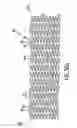 Fig. 44 - Endoprosthesis having foot extensions