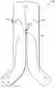 Fig. 01 - Endovascular graft with pressor and attachment methods