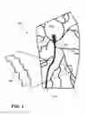 Fig. 02 - Temporary absorbable venous occlusive stent and superficial vein treatment method