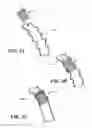 Fig. 04 - Temporary absorbable venous occlusive stent and superficial vein treatment method