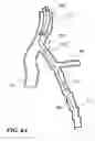 Fig. 07 - Temporary absorbable venous occlusive stent and superficial vein treatment method