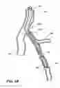 Fig. 08 - Temporary absorbable venous occlusive stent and superficial vein treatment method