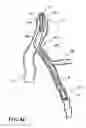 Fig. 09 - Temporary absorbable venous occlusive stent and superficial vein treatment method