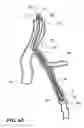 Fig. 10 - Temporary absorbable venous occlusive stent and superficial vein treatment method