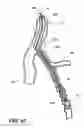 Fig. 11 - Temporary absorbable venous occlusive stent and superficial vein treatment method