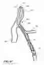 Fig. 12 - Temporary absorbable venous occlusive stent and superficial vein treatment method