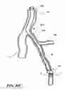 Fig. 14 - Temporary absorbable venous occlusive stent and superficial vein treatment method