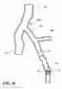 Fig. 15 - Temporary absorbable venous occlusive stent and superficial vein treatment method