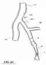 Fig. 16 - Temporary absorbable venous occlusive stent and superficial vein treatment method