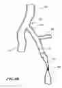 Fig. 17 - Temporary absorbable venous occlusive stent and superficial vein treatment method