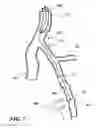Fig. 18 - Temporary absorbable venous occlusive stent and superficial vein treatment method