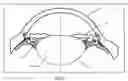 Fig. 02 - Accommodative intraocular lens and method of implantation