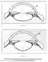 Fig. 03 - Accommodative intraocular lens and method of implantation