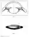 Fig. 04 - Accommodative intraocular lens and method of implantation