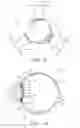 Fig. 05 - Accommodating lens with haptics