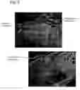 Fig. 06 - Dermal substitute consisting of amnion and biodegradable polymer, the preparation method and the use thereof