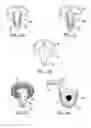 Fig. 04 - Modular humeral head resurfacing system