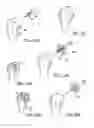 Fig. 09 - Modular humeral head resurfacing system