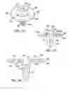 Fig. 15 - Modular humeral head resurfacing system