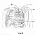 Fig. 10 - Method and apparatus for mimicking respiratory sinus arrhythmia with cardiac pacing controlled via external respiration therapy device