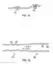 Fig. 07 - Composite stent with inner and outer stent elements and method of using the same
