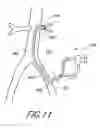 Fig. 12 - Cannulae having a redirecting tip