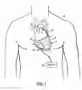 Fig. 02 - Implantable heart assist devices and methods