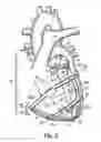 Fig. 03 - Implantable heart assist devices and methods