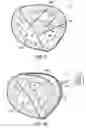 Fig. 04 - Implantable heart assist devices and methods