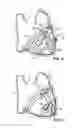 Fig. 05 - Implantable heart assist devices and methods