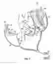 Fig. 07 - Implantable heart assist devices and methods
