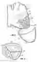 Fig. 08 - Implantable heart assist devices and methods