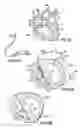 Fig. 10 - Implantable heart assist devices and methods