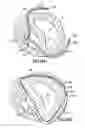 Fig. 11 - Implantable heart assist devices and methods