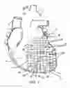 Fig. 03 - Heart support to prevent ventricular remodeling
