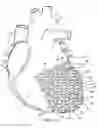Fig. 08 - Heart support to prevent ventricular remodeling