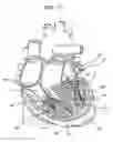 Fig. 09 - Heart support to prevent ventricular remodeling