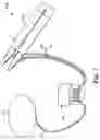 Fig. 02 - Implantable penile prosthesis pump