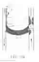 Fig. 06 - Combination thrombolytic infusion catheter and dilator system
