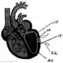 Fig. 01 - Shaping suture for treating congestive heart failure