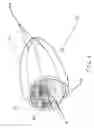 Fig. 06 - Shaping suture for treating congestive heart failure