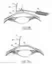 Fig. 06 - System for packaging and handling an implant and method of use