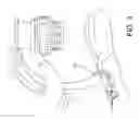 Fig. 04 - Surgical navigation systems and processes for unicompartmental knee arthroplasty
