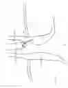 Fig. 09 - Surgical implant
