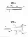 Fig. 03 - Surgical balloon having varying wall thickness