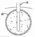 Fig. 01 - Method and device for cavity obliteration